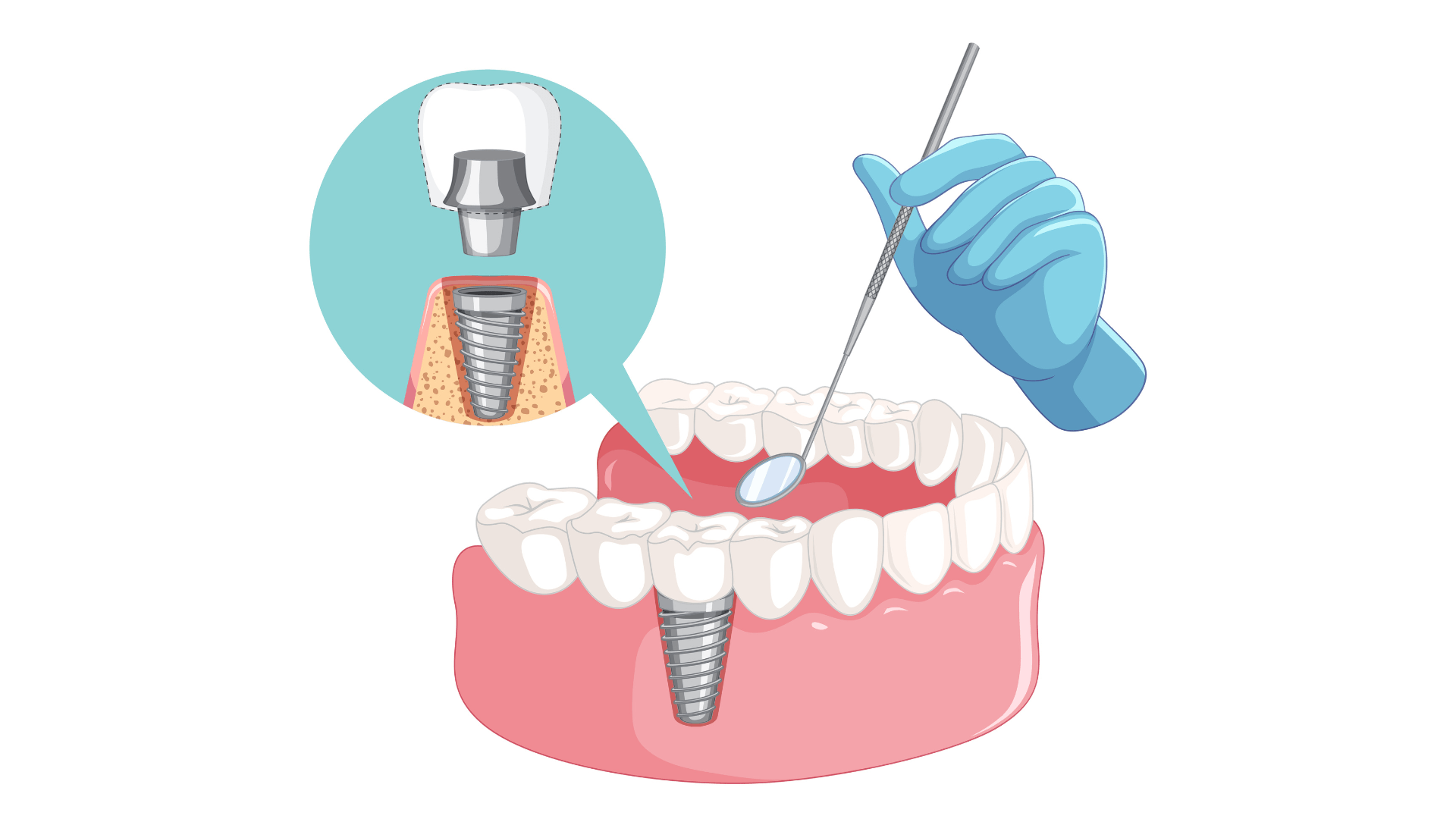Dental Implants