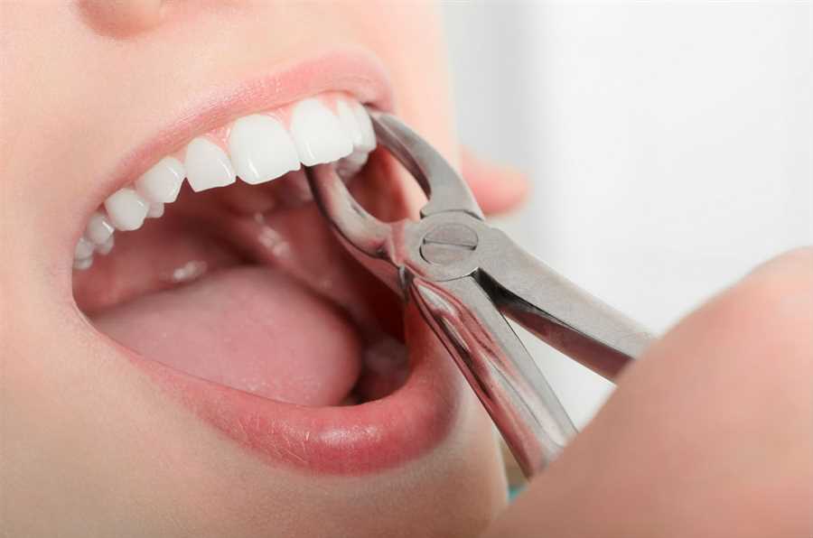Wisdom Tooth Extractions in Oakville