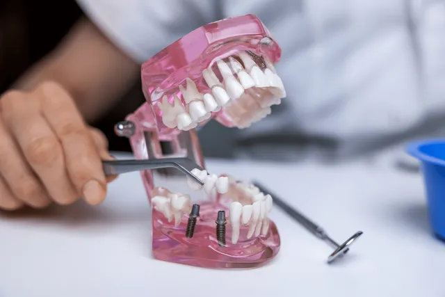 Dental Bridge in Oakville