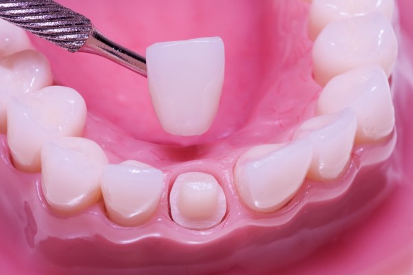 Dental Crowns in Oakville