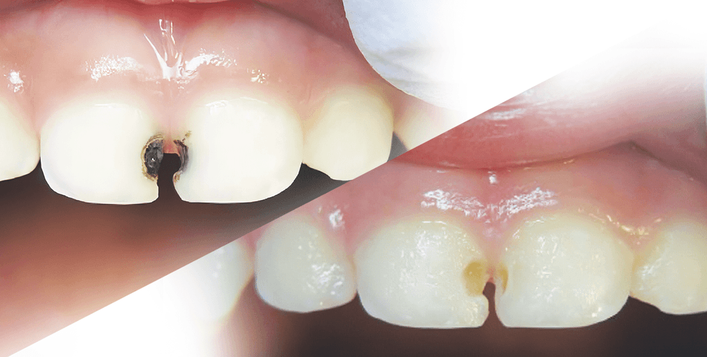Fluortide Treatment in Oakville