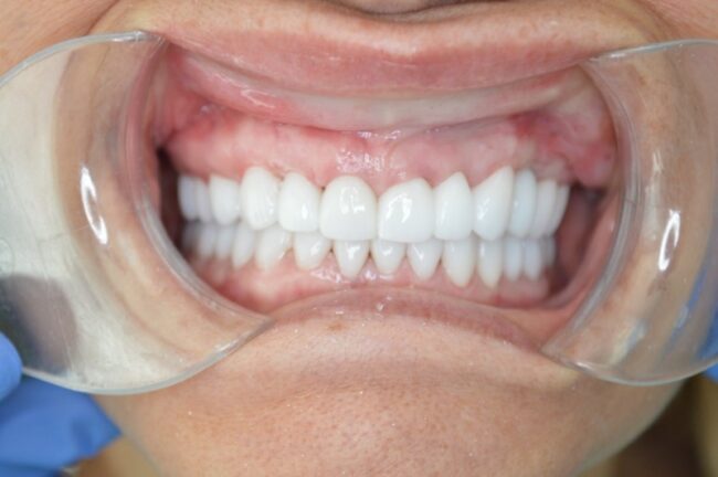 Full Mouth Reconstruction in Oakville