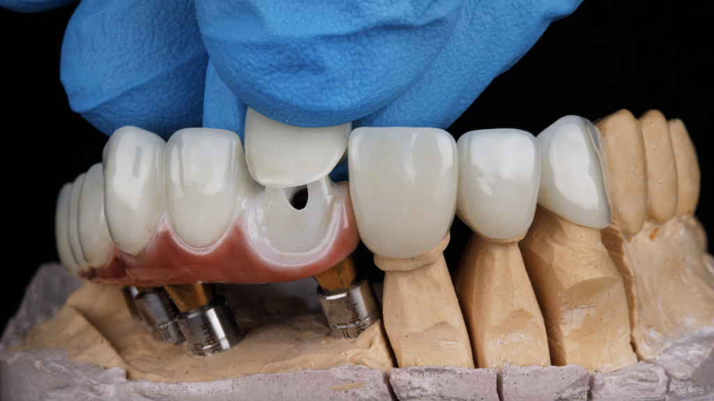Dentak Implants in Oakville