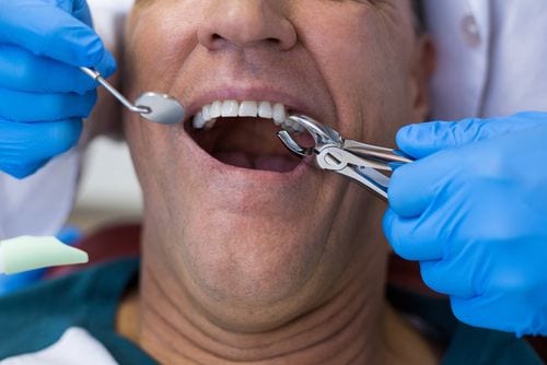 Tooth Extractions in Oakville