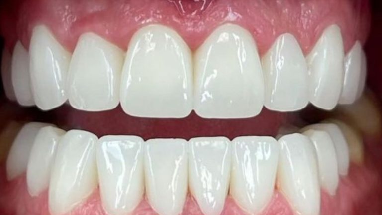 Invisalign Clear Aligner Result in Oakville