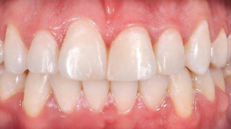 Invisalign Result in Oakville
