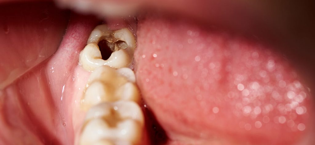 Fluortide Treatment in Oakville