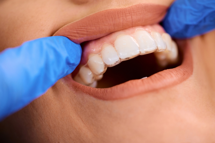 Invisalign in Oakville