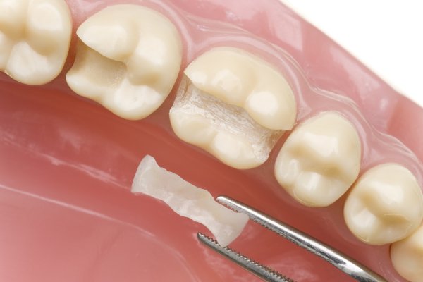 Dental Sealants in Oakville