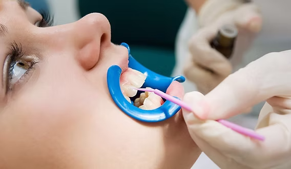 Fluortide Treatment in Oakville