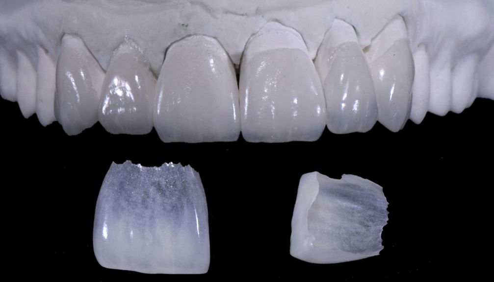 Dental Veneers in Oakville