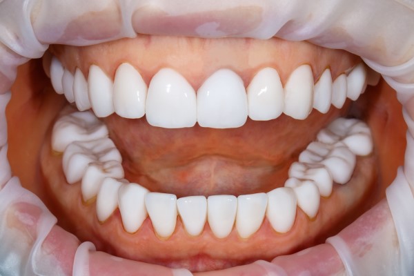 Smile Makeover in Oakville