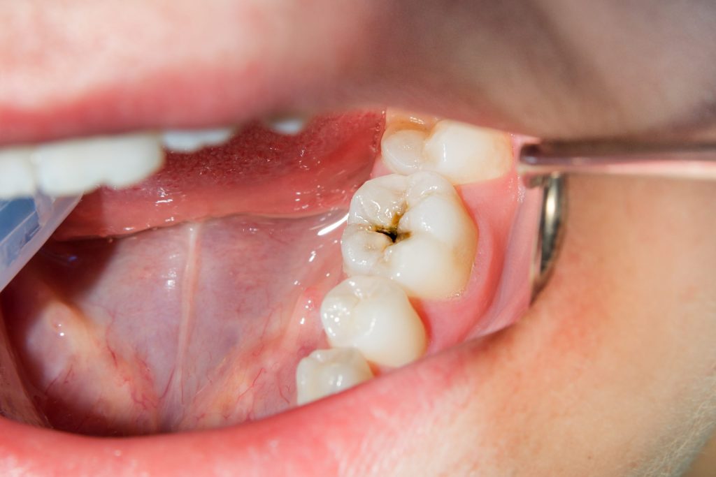 Dental Sealants in Oakville
