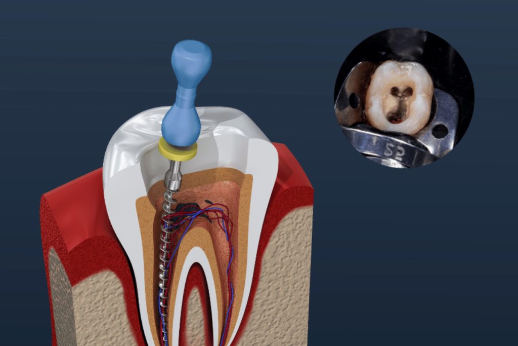 Root canals treatment