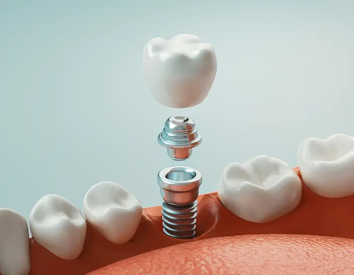dental-implants-2